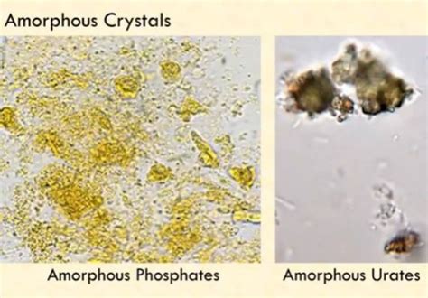amorphous crystals medical laboratories
