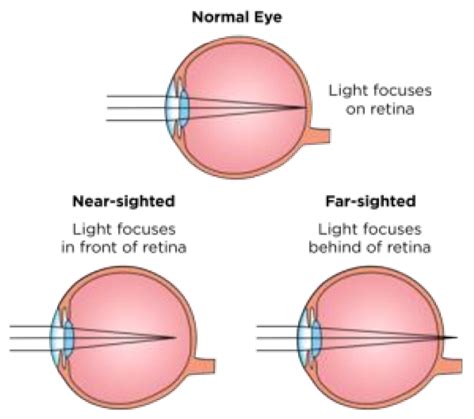 myopia hyperopia presbyopia  astigmatism image source   scientific diagram