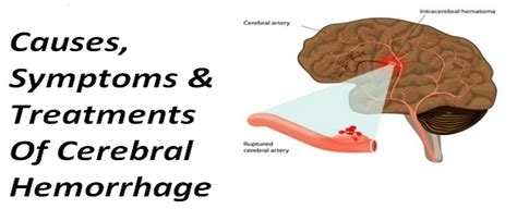 cerebral hemorrhage symptoms causes andtreatments homeopathic treatment