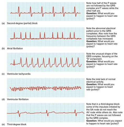 Different Forms Of Cardiac Arrhythmia Shown In An Electrocardiogram