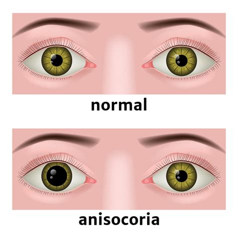 anisocoria unequal pupils board certified eye doctors