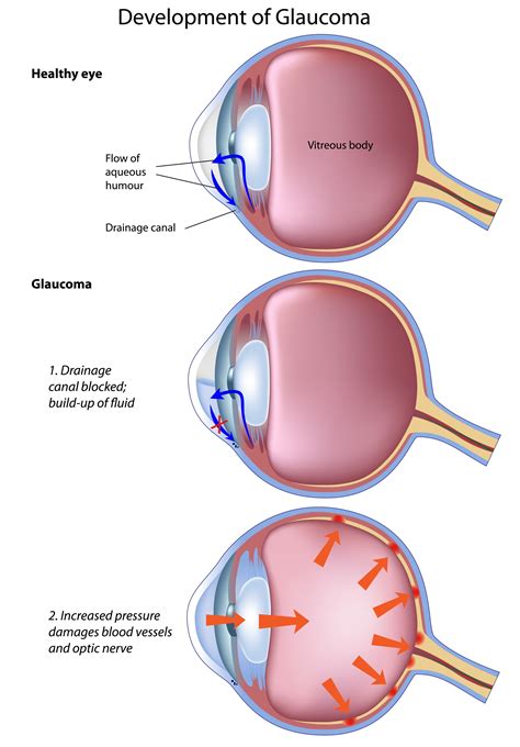 glaucoma petrou eye care