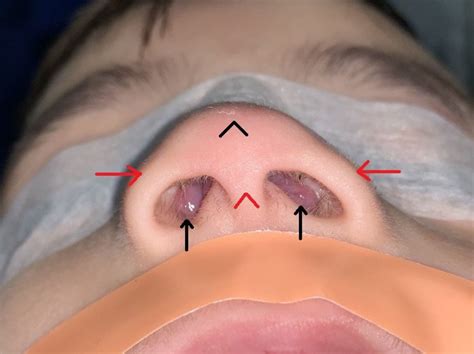inferior turbinate hypertrophy presenting  bilateral nasal masses   paediatric patient