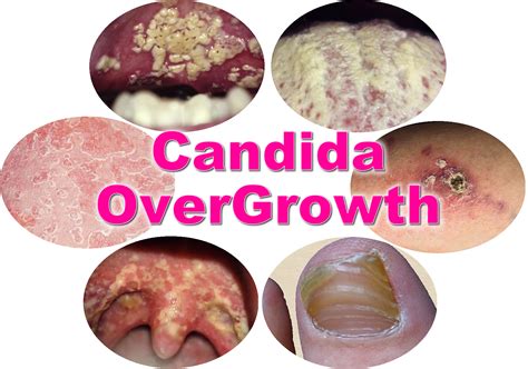 fixing fungal and candida overgrowth podcast 102 just
