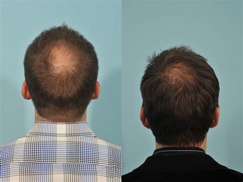 hair transplant before and after 2 jesse e smith md facs ft worth