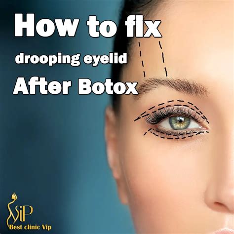 fix drooping eyelids  botox vip clinic