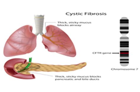 cystic fibrosis cf