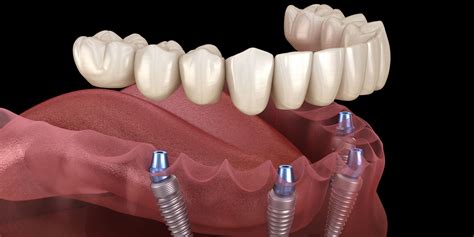 implants fremont santa clara ca teeth   day