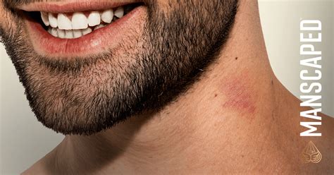 how to get rid of hickeys manscaped™ blog
