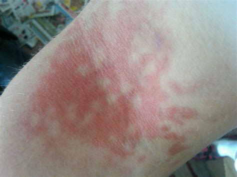 erythema ab igne cure pictures