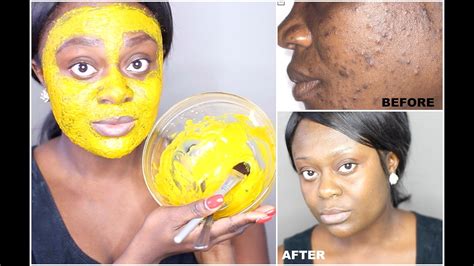 diy turmeric face mask  acne treatment  clear bright  acne  skin   days