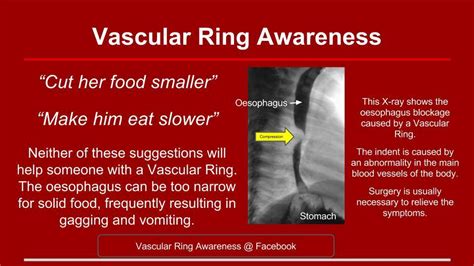 vascular ring awareness home facebook