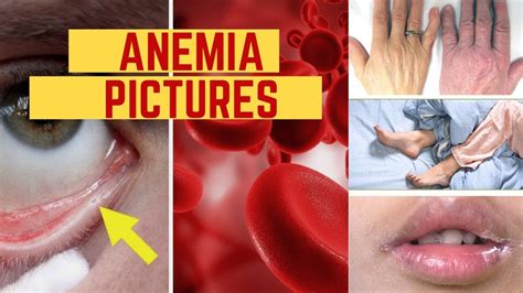anemia pictures early signs symptoms  images  pictures