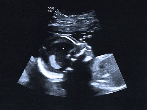 week ultrasound pictures procedure