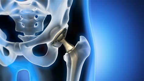 zimmer biomet receives fda nod  rosa total hip system intensifying