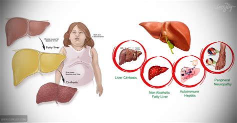Non Alcoholic Fatty Liver Disease Nafld Causes And Symptoms