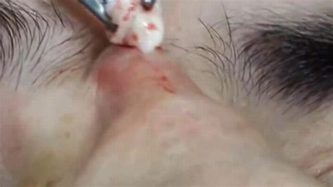 Doctor Removes Huge Cyst From Man S Nose By Burning Away Skin With