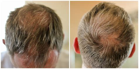 hair thinning  hair loss whats  man   clever housewife