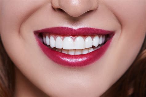 dental veneer services  oxford nc