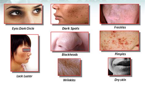 skin facial problems facials  acne  farmingville ny  ways