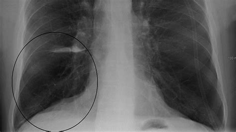 Copd X Ray Pictures Diagnosis And More