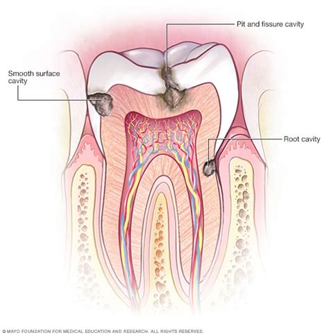 cavities  tooth decay diagnosis  treatment mayo clinic