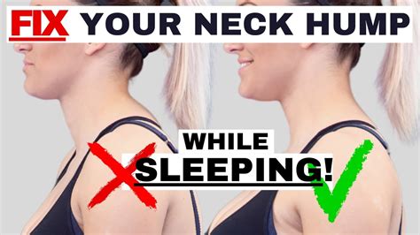 Best Sleeping Position To Fix Neck Hump Hunchback Or Forward Head