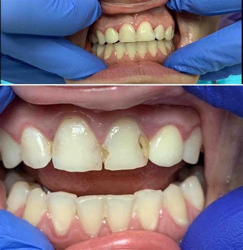 front teeth fillings