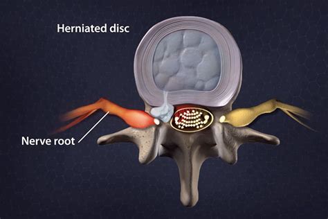 hackettstown herniated disc back surgery ess