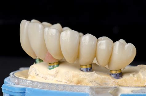 implant supported full arch restorations    teeth tomorrow