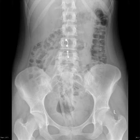 Rectal Foreign Bodies Radiology Reference Article