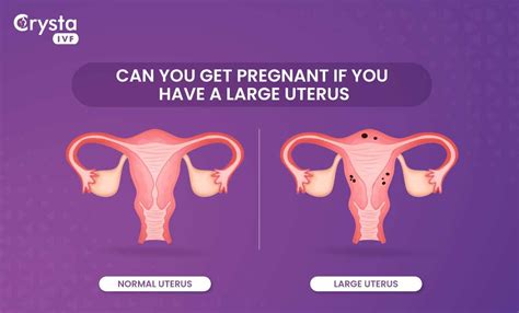Bulky Uterus Meaning Can You Get Pregnant With Enlarged Uterus