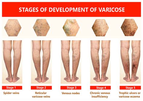Varicose Veins On A Female Senior Leg Vein And Vascular