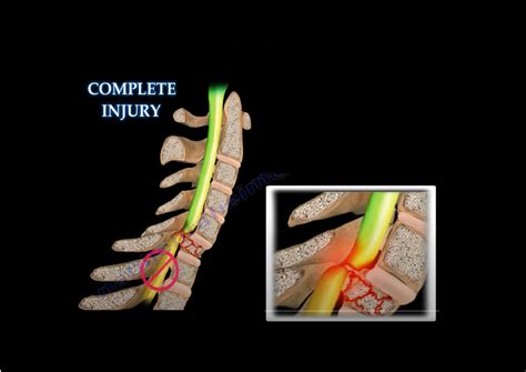 spinal cord injury incomplete  complete orthopaedicprinciplescom