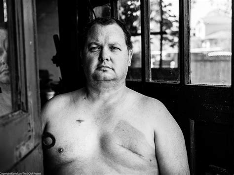 When Men Get Breast Cancer The New York Times