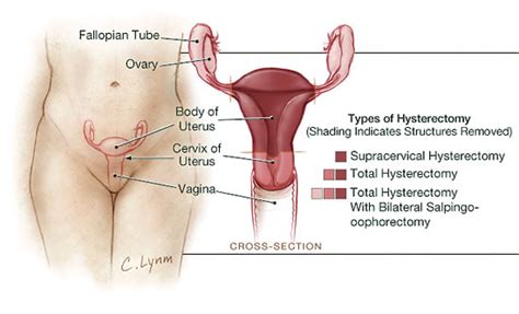 Hysterectomy Patient Information Jama Jama Network