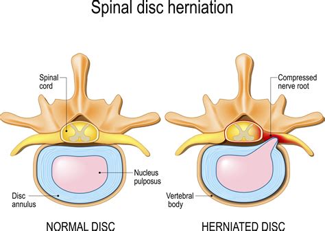Lumbar Disc Herniation Sciatica Upswing Health