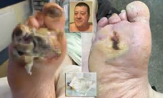 man s foot with giant burn hole saved by maggots daily mail online