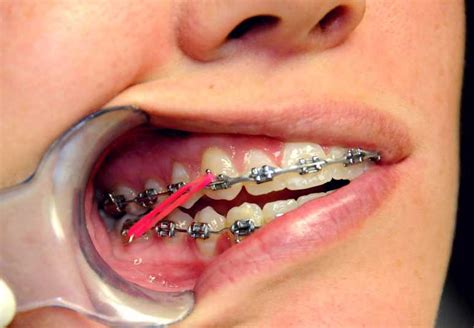 elastic rubber bands  braces    orthodontistcom