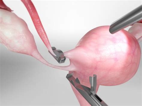 video tubal ligation laparoscopic tubal clip method healthclips