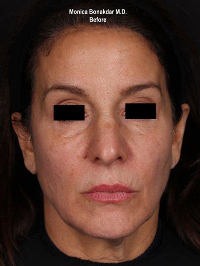 before and after upper face and temples procedures in newport beach ca