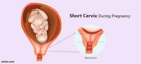 Short Cervix During Pregnancy Causes And Treatment