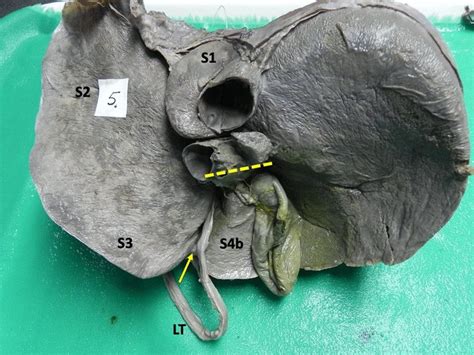 View Of The Visceral Surface Of The Liver Demonstrating Classic