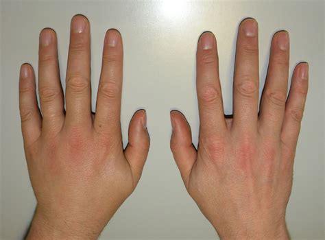 sprained finger facts general center steadyhealthcom