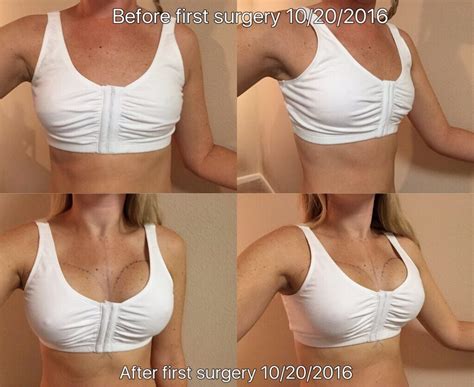 Breast Augmentation Over Muscle