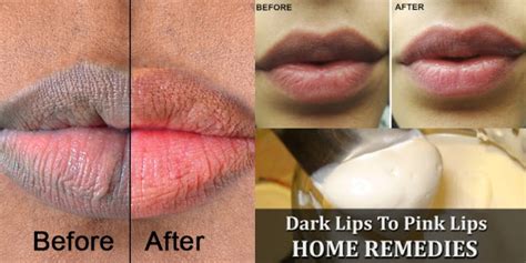 9 home remedies to treat dark lips
