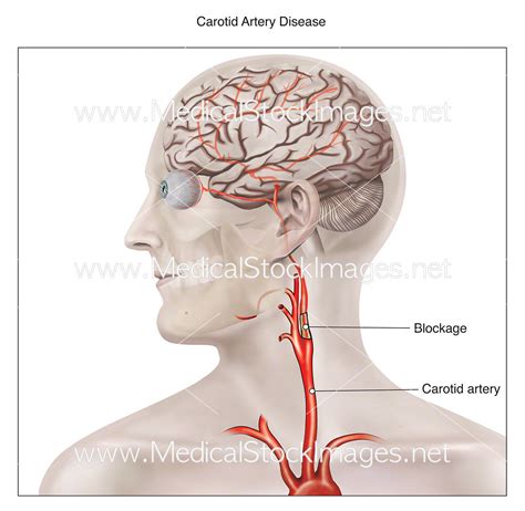carotid artery disease medical stock images company