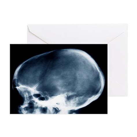 dolichocephalic skull deformity  ray greeting  sciencephotos