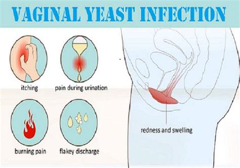 Vaginal Yeast Infection Treatment In Lahore Yeast Infection In Vagina