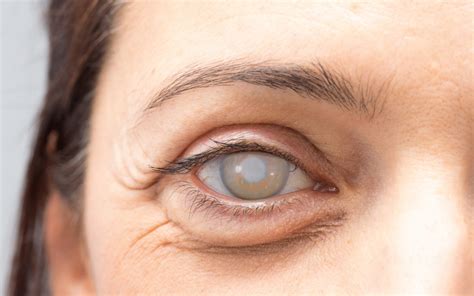 cataract surgery  london eye clinic hooman sherafat